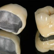 Металлокерамика