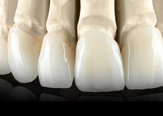 Безметалловая керамика E-MAX